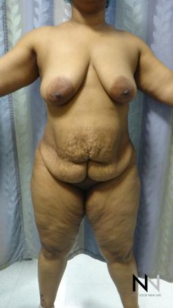 Abdominoplasty: Patient 23 - Before 1