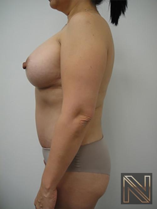 Abdominoplasty: Patient 20 - After 2