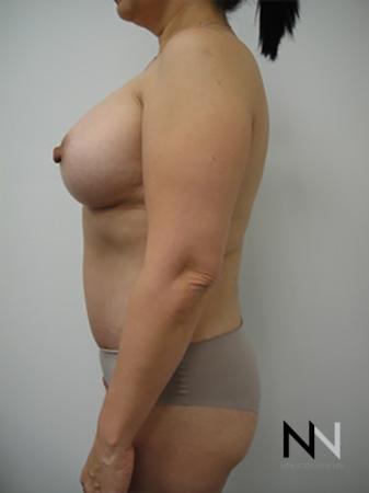 Abdominoplasty: Patient 20 - After Image 2