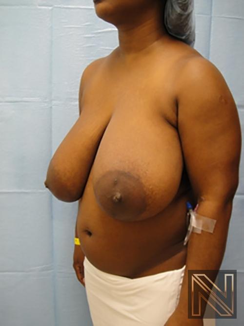 Breast Reduction: Patient 3 - Before 2