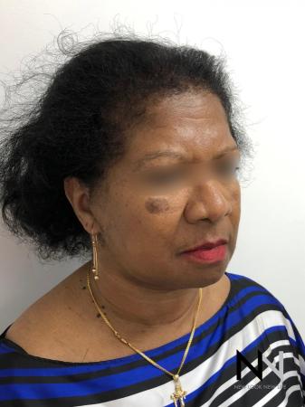 Facelift/Mini Facelift: Patient 7 - After Image 4