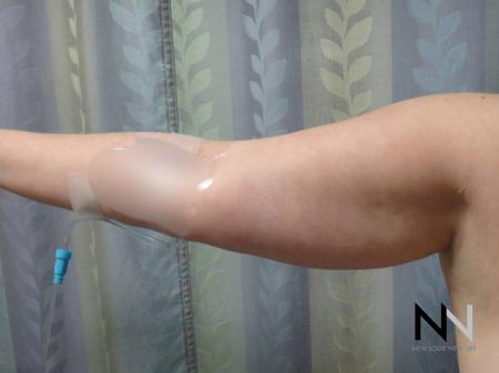 Liposuction: Patient 24 - Before Image 2