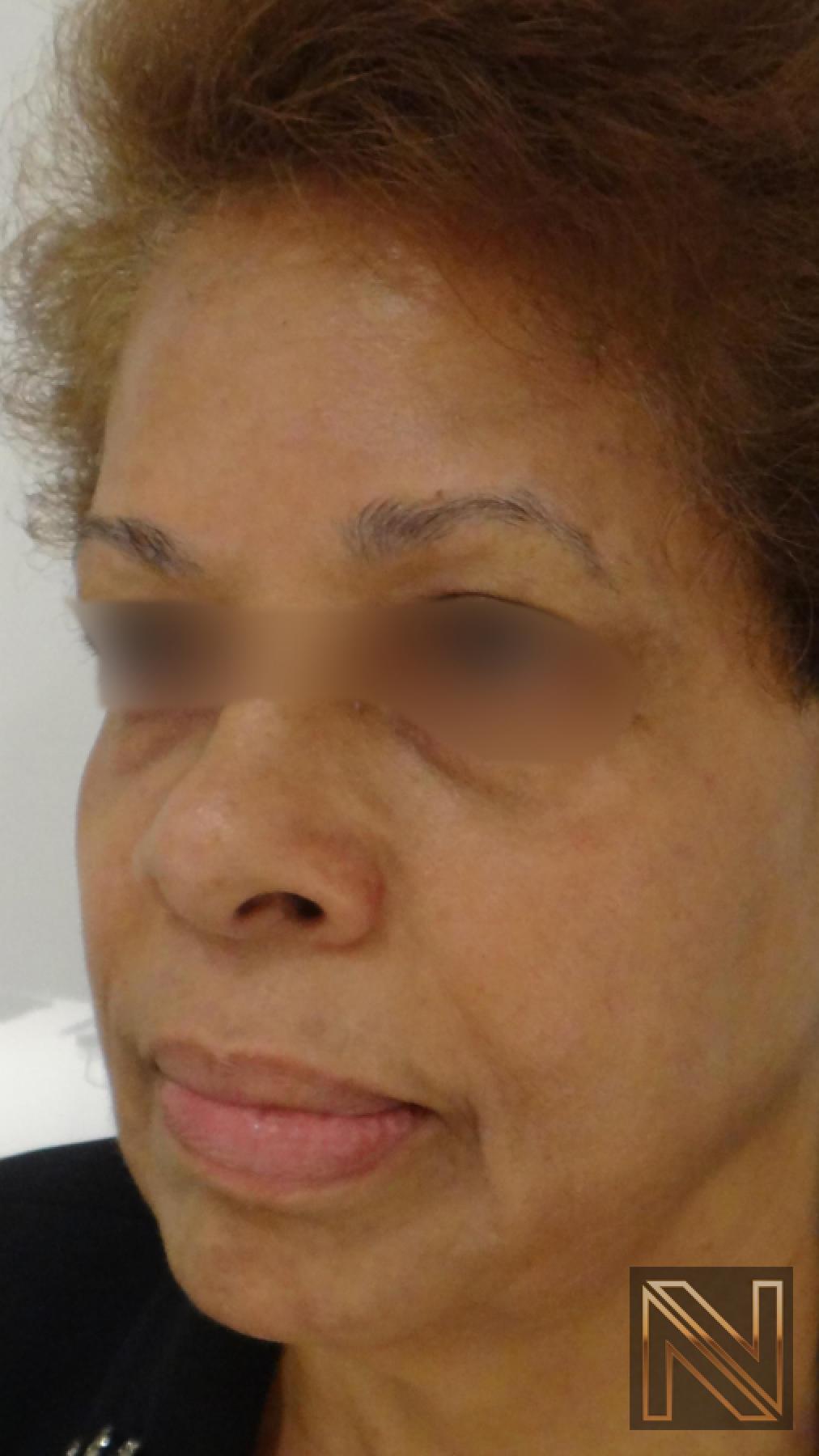 Laser Skin Resurfacing - Face: Patient 2 - After 2
