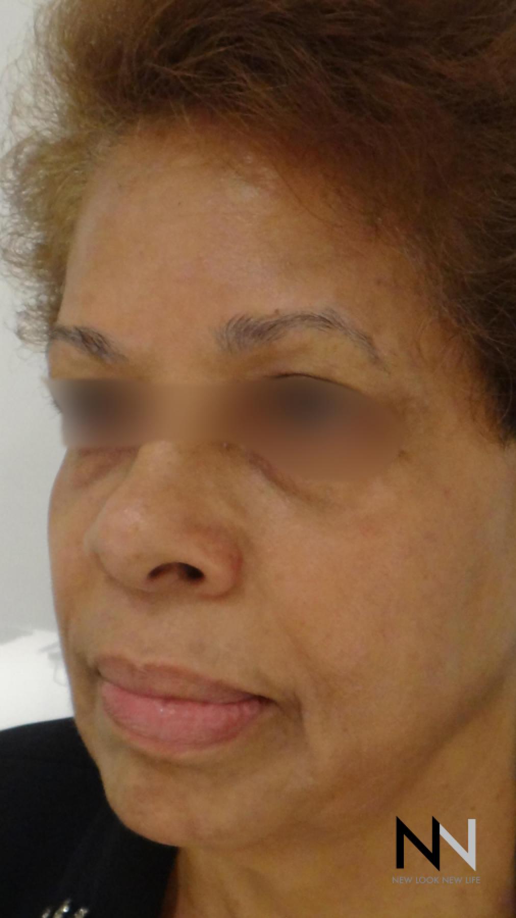 Laser Skin Resurfacing - Face: Patient 2 - After 2