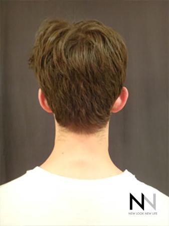 Otoplasty And Earlobe Repair: Patient 1 - Before Image 1