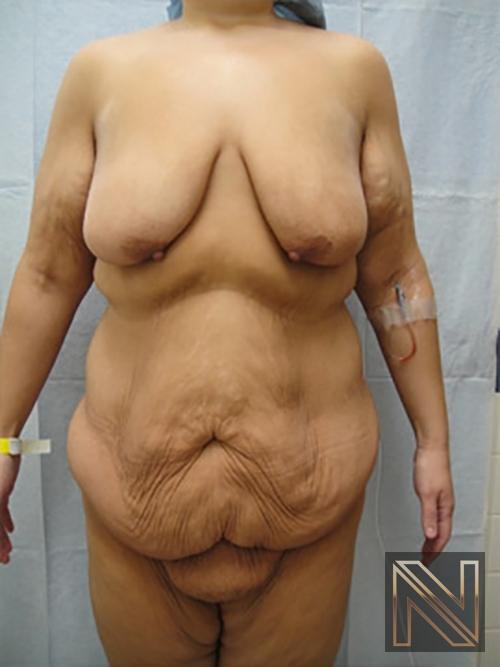 Abdominoplasty: Patient 17 - Before 1