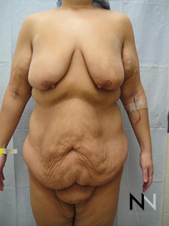 Abdominoplasty: Patient 17 - Before 1