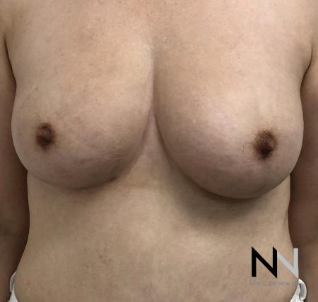 Fat Transfer - Body: Patient 2 - After Image 5