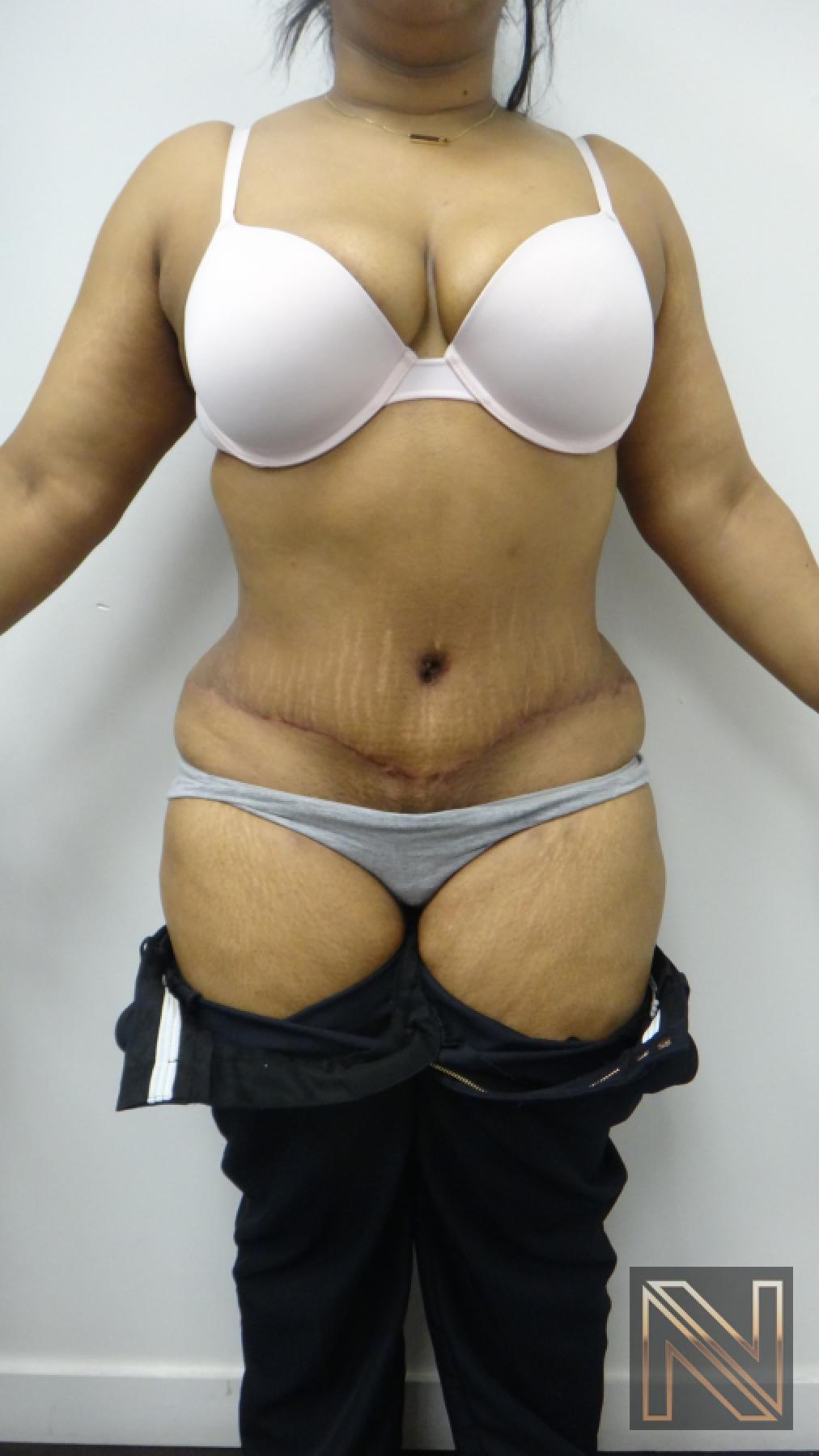 Abdominoplasty: Patient 23 - After 1