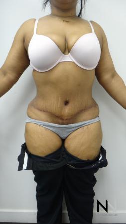 Abdominoplasty: Patient 23 - After 1
