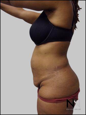 Mini Tummy Tuck: Patient 3 - Before and After Image 3