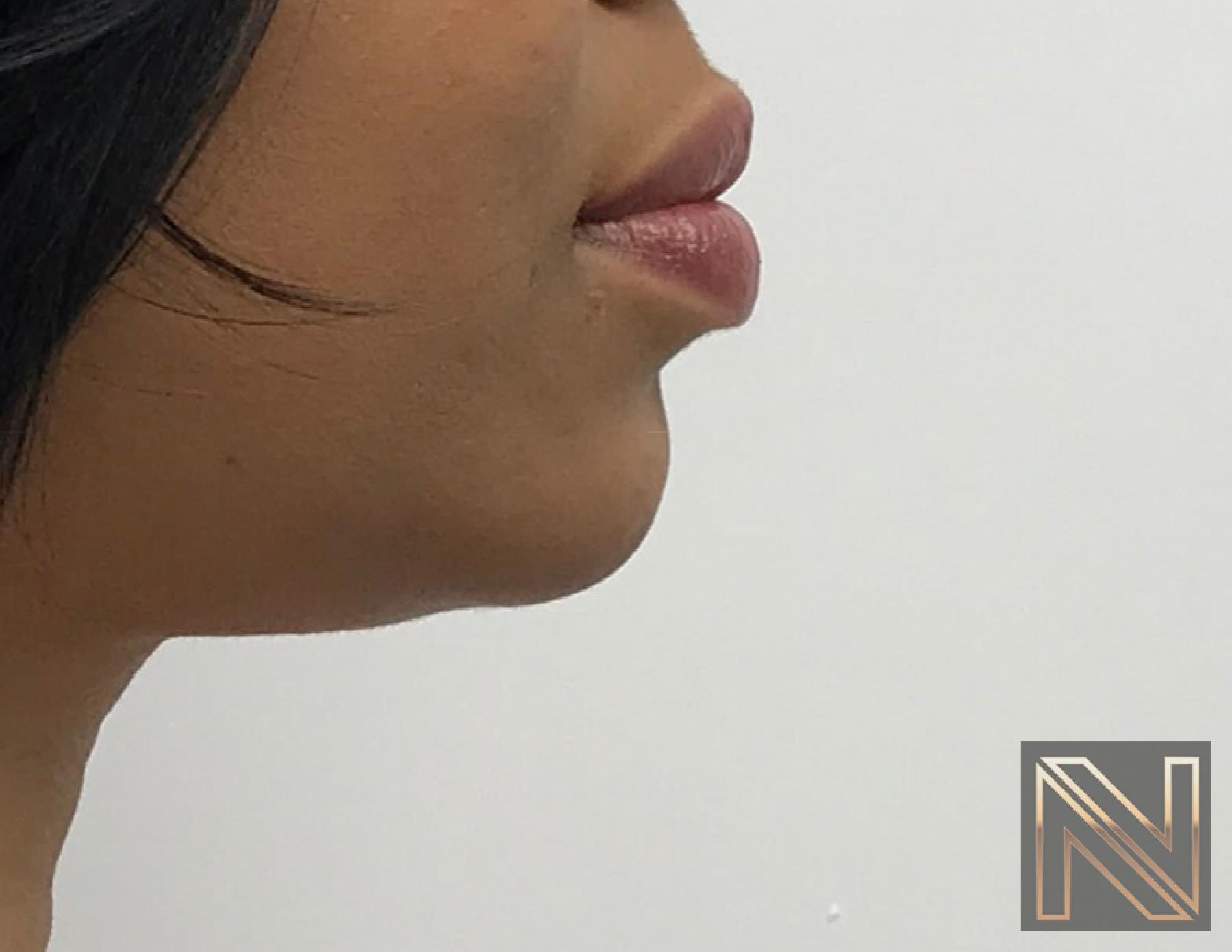 Chin Augmentation: Patient 3 - After 4