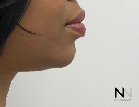 Chin Augmentation: Patient 3 - After Image 4