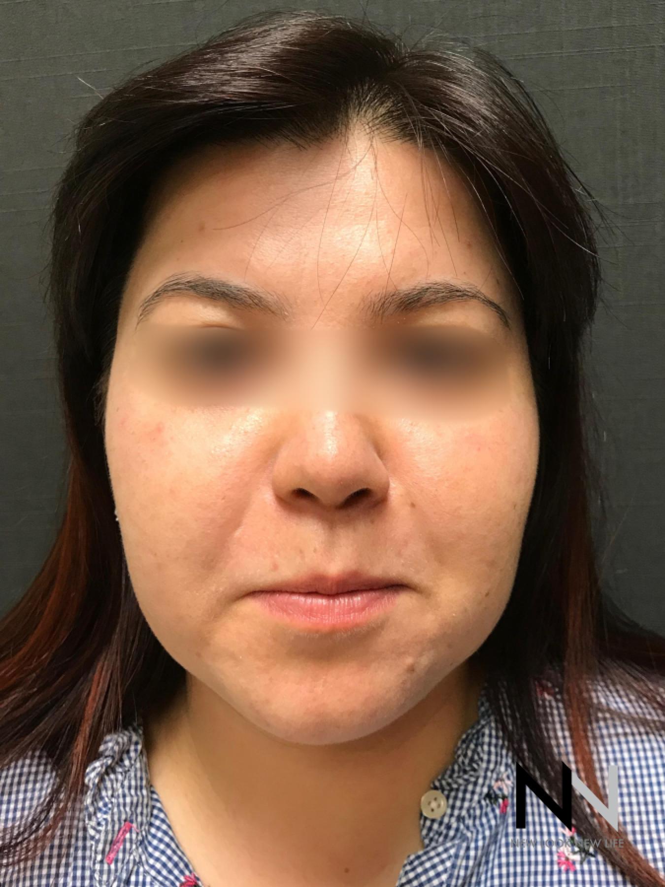 Fractional Resurfacing: Patient 5 - After 1