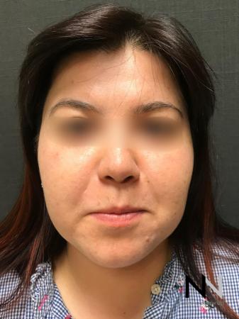 Fractional Resurfacing: Patient 5 - After Image 1