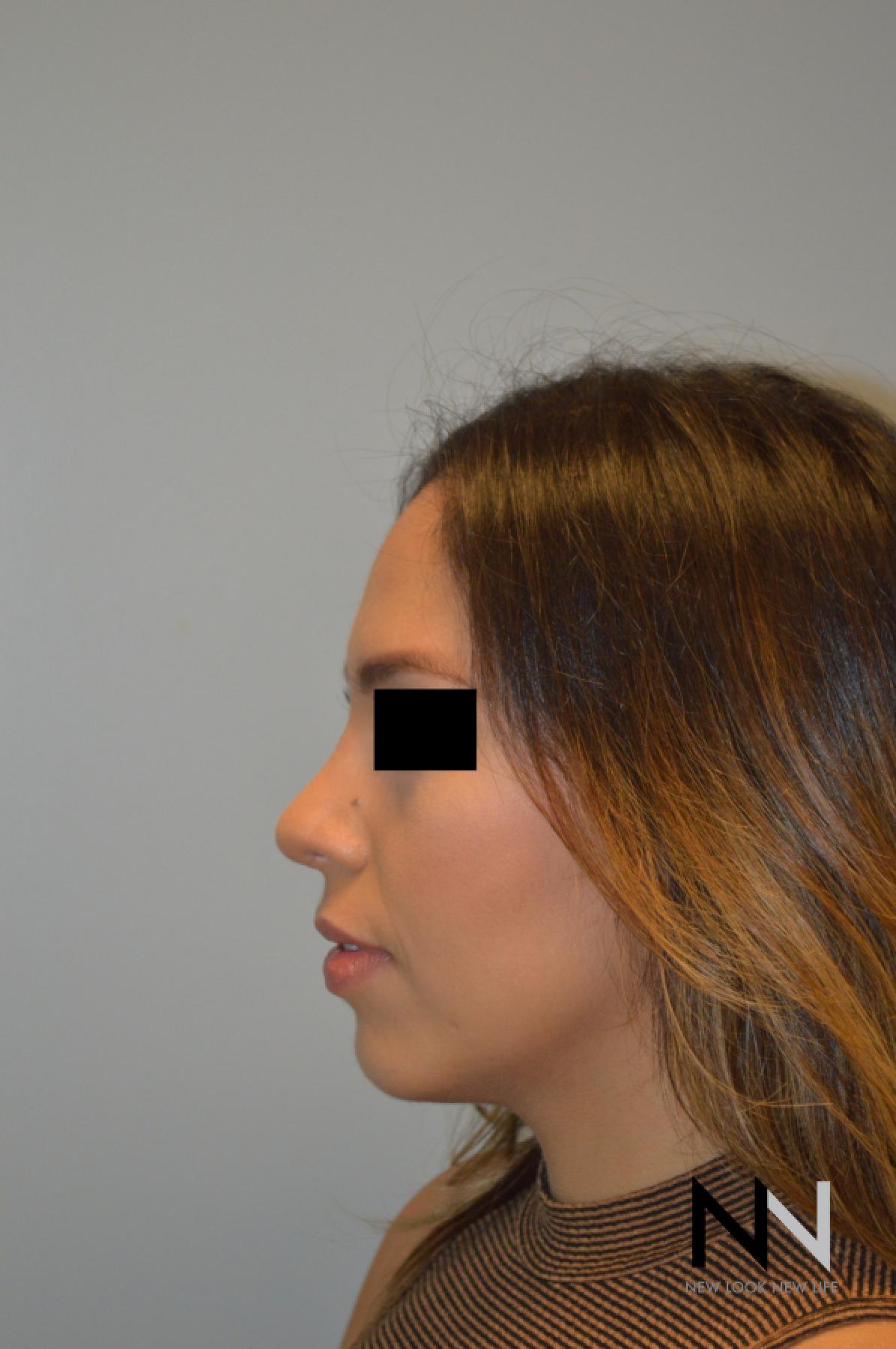 Rhinoplasty: Patient 6 - After 2