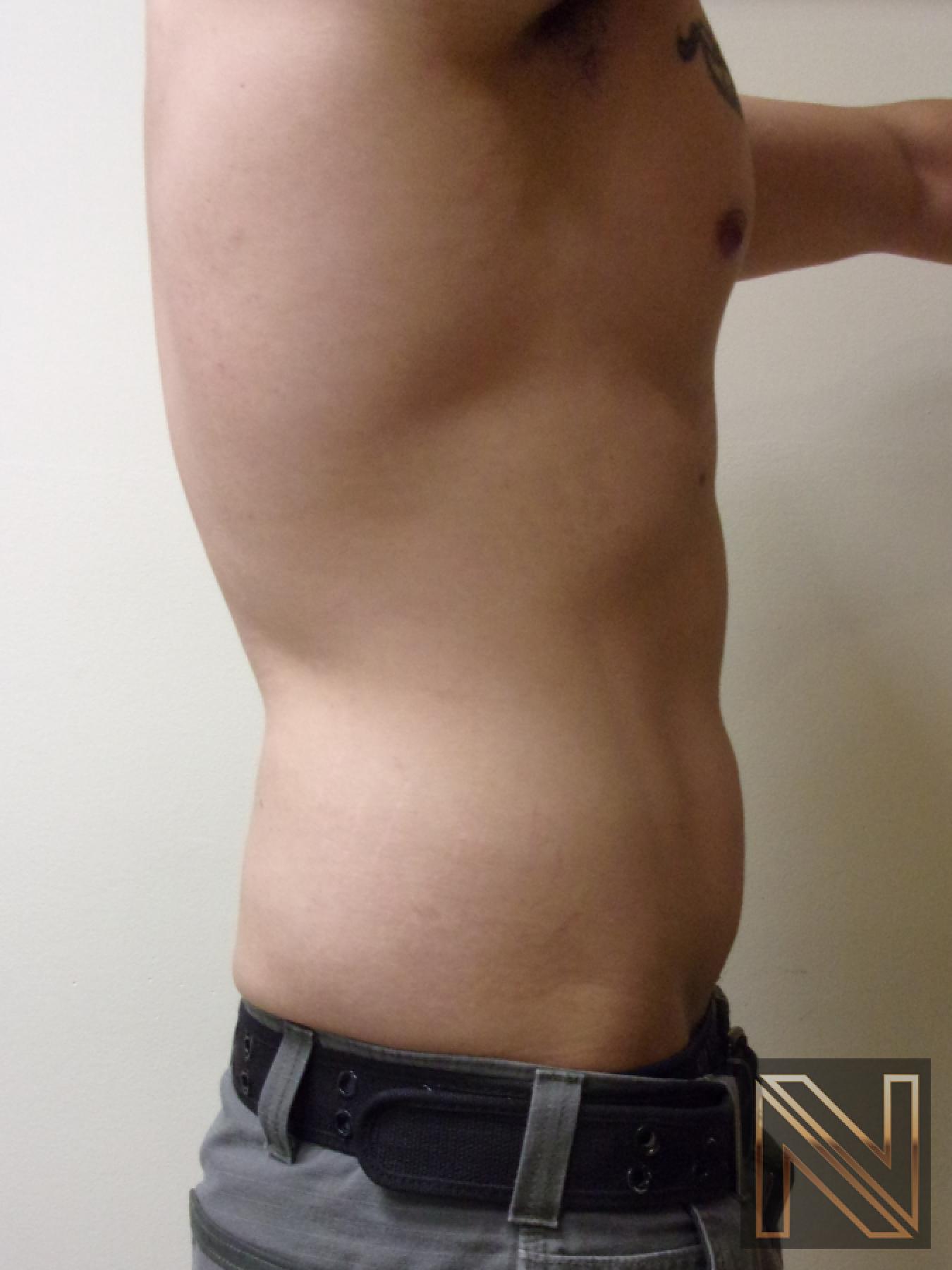 Liposuction: Patient 14 - After 3