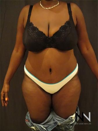 Abdominoplasty: Patient 9 - After Image 1