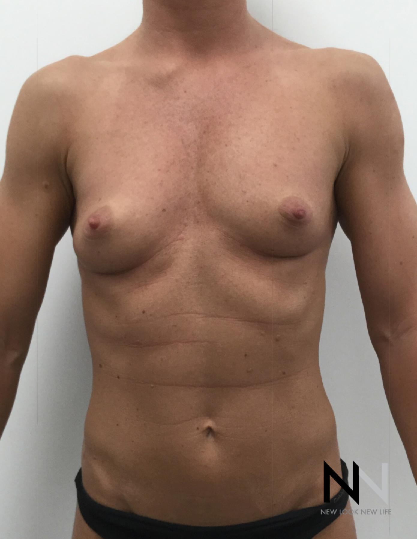 Breast Augmentation: Patient 3 - Before 1