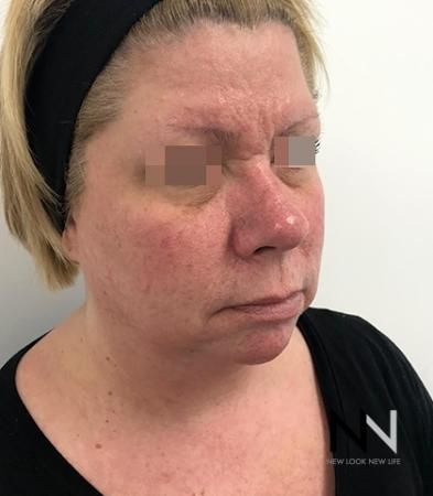 Fractional Resurfacing: Patient 2 - Before Image 2