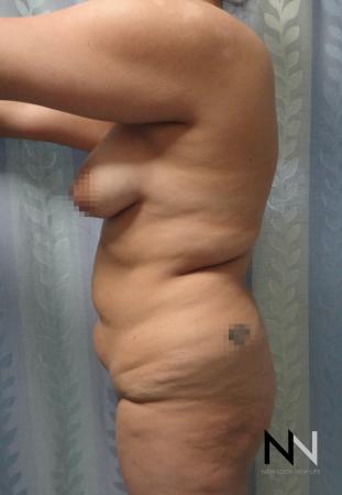 Butt Augmentation: Patient 5 - Before Image 2
