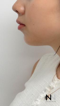 Chin Augmentation: Patient 2 - After Image 1