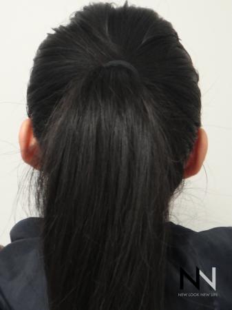 Otoplasty And Earlobe Repair: Patient 6 - After Image 1