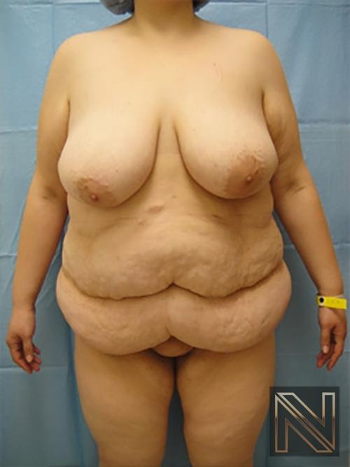 Abdominoplasty: Patient 15 - Before 1