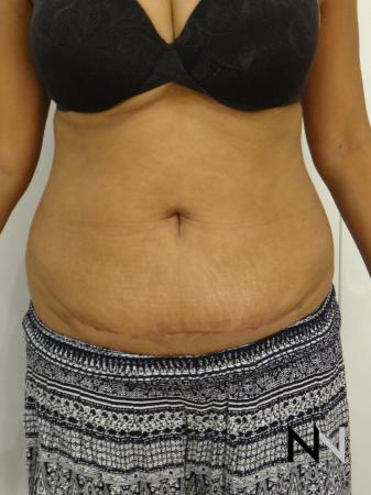 Mini Tummy Tuck: Patient 4 - After Image 1