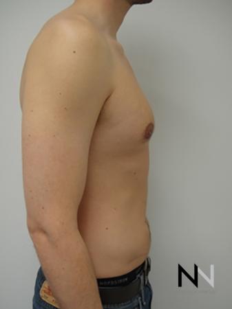 Gynecomastia: Patient 4 - After Image 5