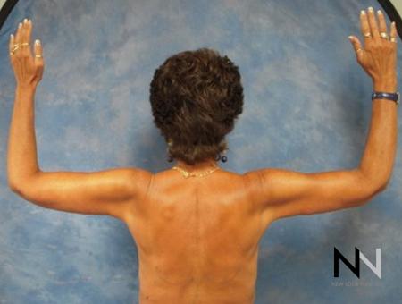 Brachioplasty: Patient 1 - After Image 1