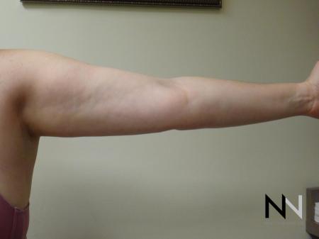 Liposuction: Patient 24 - After Image 3