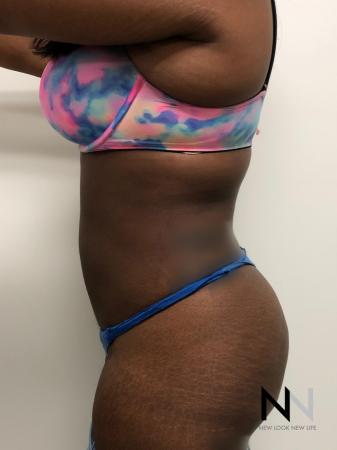 Liposuction: Patient 3 - After Image 2