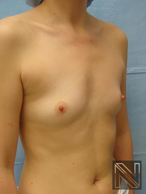Breast Augmentation: Patient 5 - Before 3