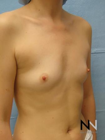 Breast Augmentation: Patient 5 - Before Image 3