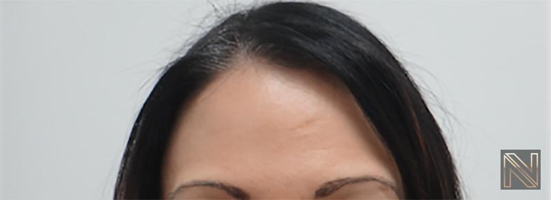 BOTOX® Cosmetic: Patient 5 - After 1