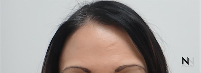 BOTOX® Cosmetic: Patient 5 - After 1