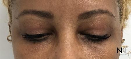 Blepharoplasty: Patient 1 - After Image 2