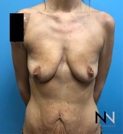 Breast Lift: Patient 18 - Before Image 1