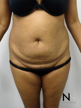 Mini Tummy Tuck: Patient 4 - Before Image 1