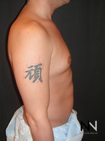 Gynecomastia: Patient 2 - Before and After Image 5
