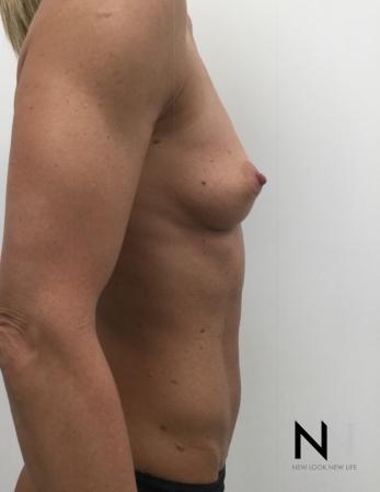 Breast Augmentation: Patient 3 - Before and After Image 3