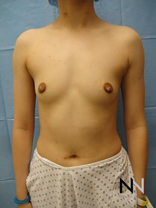 Breast Augmentation: Patient 4 - Before 