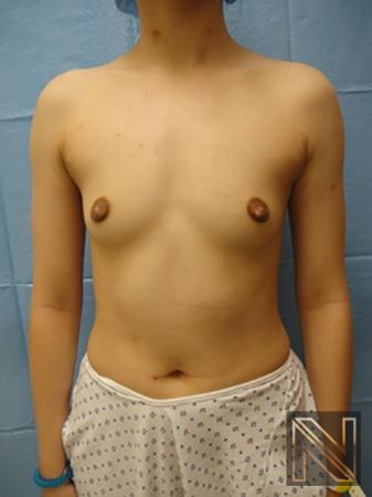 Breast Augmentation: Patient 4 - Before 
