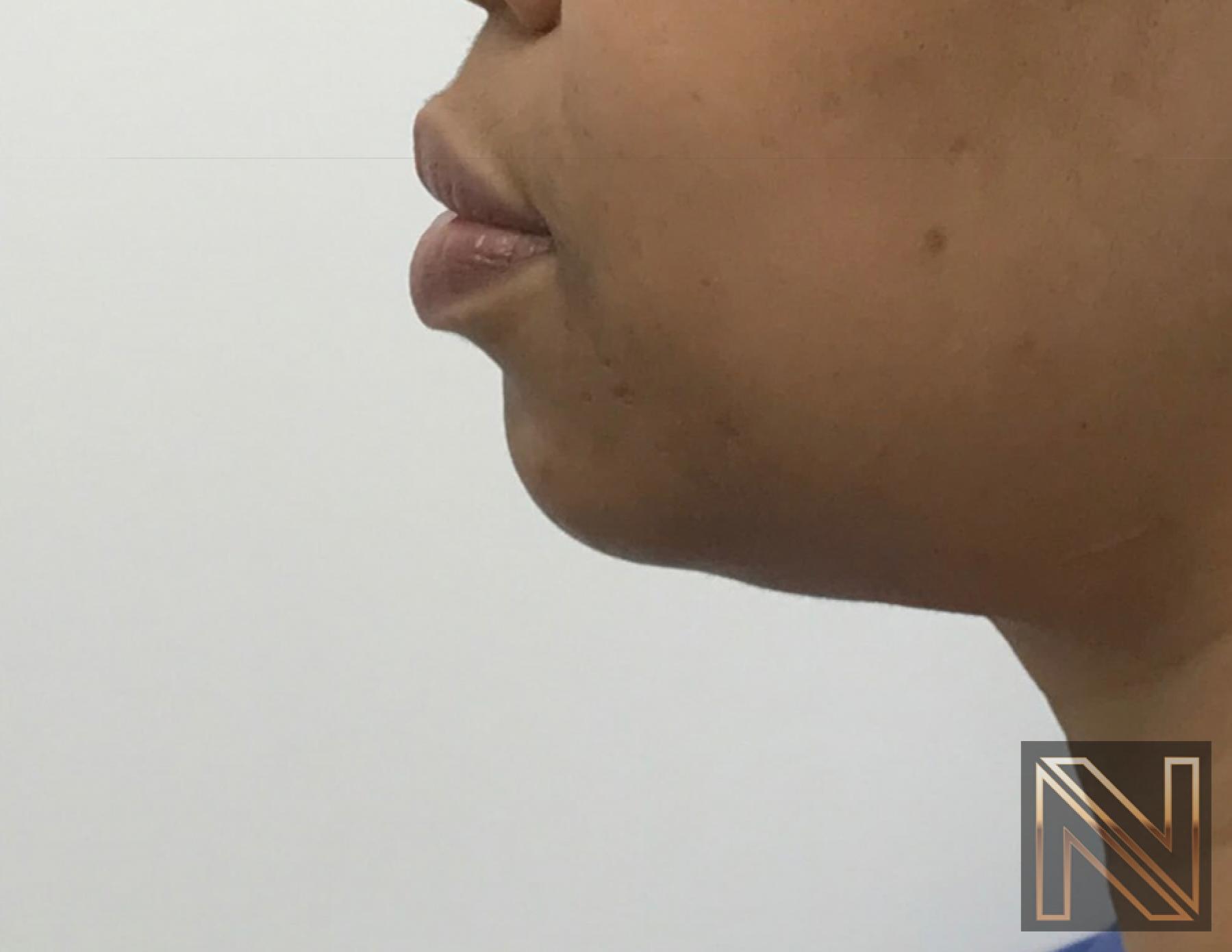 Chin Augmentation: Patient 3 - Before and After 5