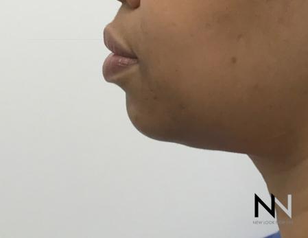 Chin Augmentation: Patient 3 - Before and After Image 5