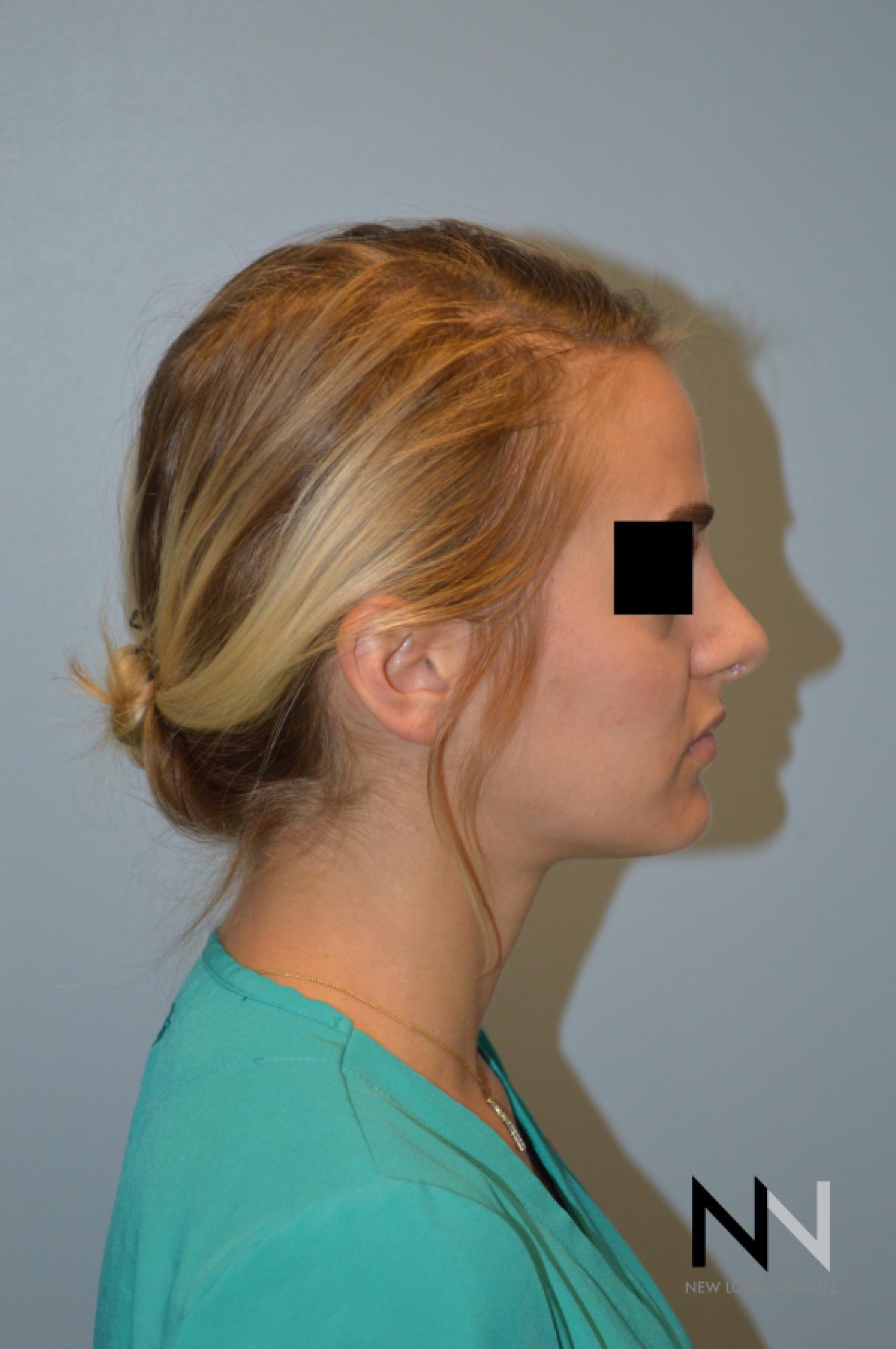 Rhinoplasty: Patient 3 - After  