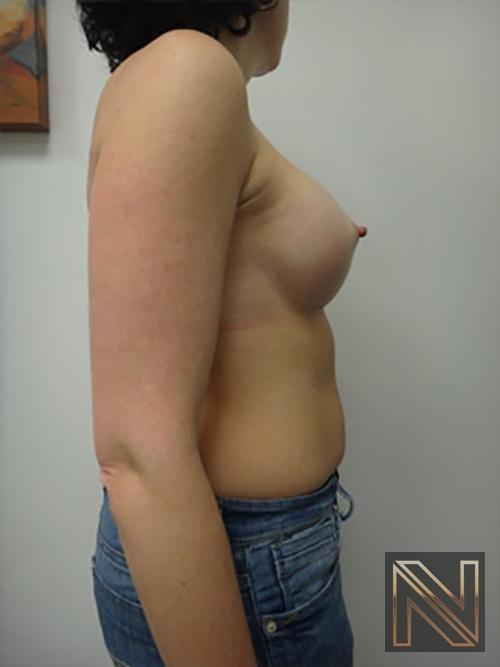 Breast Augmentation: Patient 9 - After 5