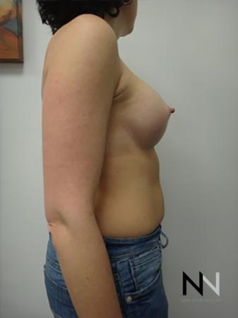 Breast Augmentation: Patient 9 - After Image 5
