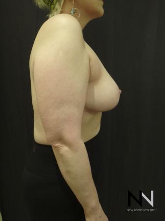 Breast Lift: Patient 3 - After Image 5